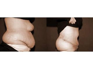 Abdominoplastyka - przed i po