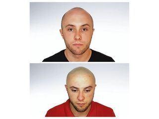 Przed i po - mikropigmentacja