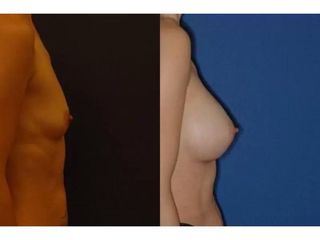 Lipofiling piersi - przed i po
