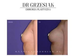 Powiększenie piersi implantami - efekty