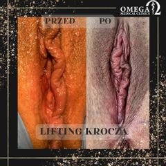 Labioplastyka - OMEGA Estetica