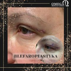 Blefaroplastyka - OMEGA Estetica