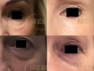 Anti-aging przed i po - 877021