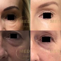 Okolica oka . 2 pacjentki.