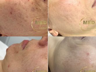 Usuwanie blizn przed i po - 877048