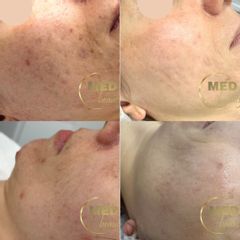 Leczenie blizn potrądzikowych. 1 zabieg