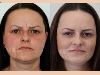 Kwas hialuronowy przed i po - 877049