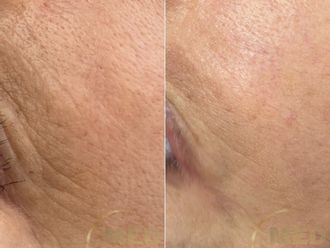 Anti-aging przed i po - 877050