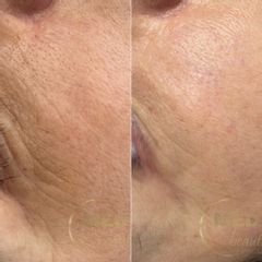 Peeling chemiczny. TCA.