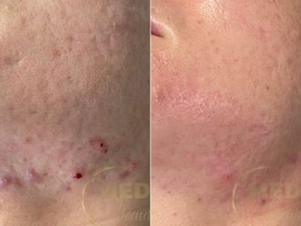 Usuwanie blizn przed i po - 877051