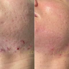 Leczenie trądziku i blizn potrądzikowych. Pierwszy etap.