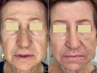 Peeling chemiczny przed i po - 877052