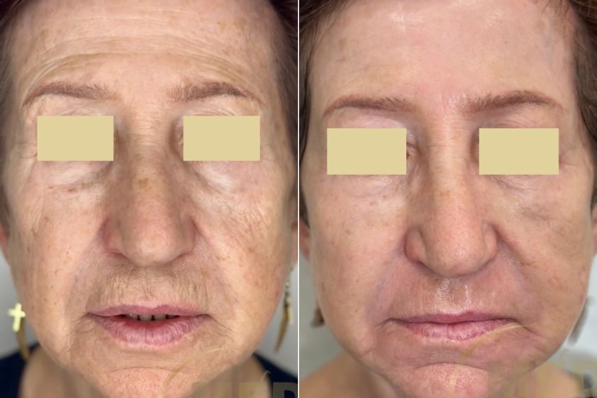 Peeling chemiczny przed i po - 877052