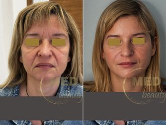 Anti-aging przed i po - 877054