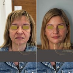 Naturalny Full face lift. Kwas hialuronowy 7ml + toksyna botulinowa.