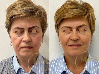 Anti-aging przed i po - 877055