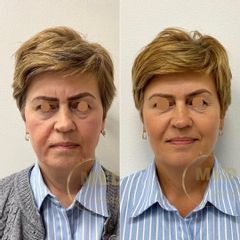 Full face lift. Kwas hialuronowy , toksyna botulinowa.