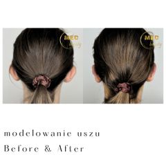 Otoplastyka Med-beauty