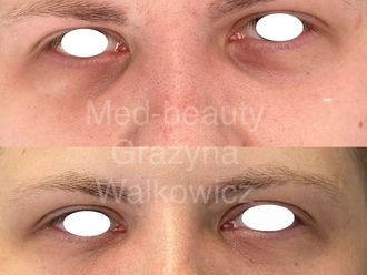 Mezoterapia igłowa przed i po - 877081