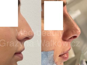 Nici liftingujące przed i po - 877100