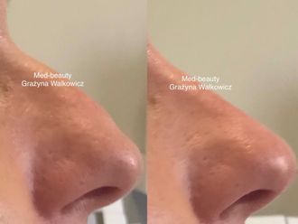 Kwas hialuronowy przed i po - 877101