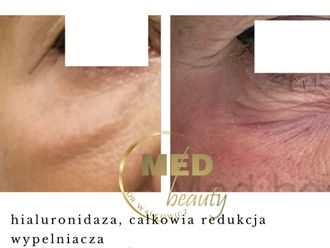Hialuronidaza przed i po - 877102