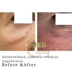 Before & After Hialuronidaza