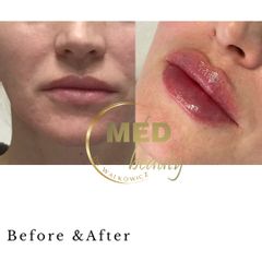 Before &After modelowanie ust