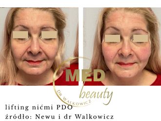 Nici liftingujące przed i po - 877104