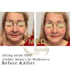 Before &After nici pdo