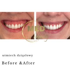 Before & After uśmiech dziąsłowy.