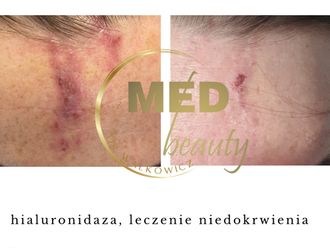 Hialuronidaza przed i po - 877106