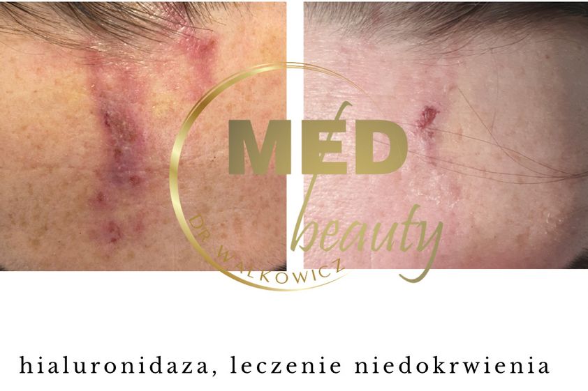 Hialuronidaza przed i po - 877106