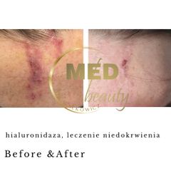 Leczenie powkłań Before &After