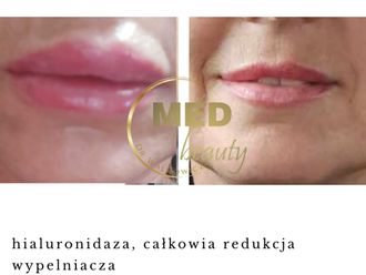 Hialuronidaza przed i po - 877107