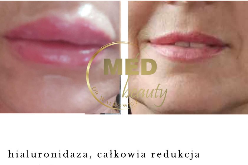 Hialuronidaza przed i po - 877107
