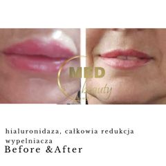 Before &After leczenie powikłań