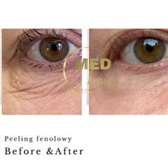 Before &After peeling fenolowy