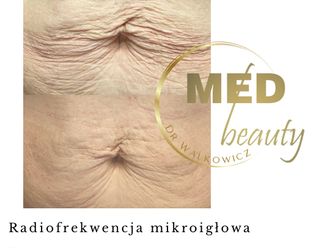 Radiofrekwencja mikroigłowa przed i po - 877109