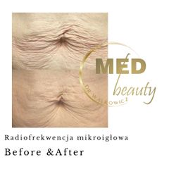 Before &After radiofrekwencja mikroiglowa