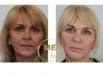 Kwas hialuronowy przed i po - 877110