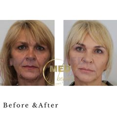 Before &After Redukcja zmarszczek kwasem hialuronowym i toksyną botulinową