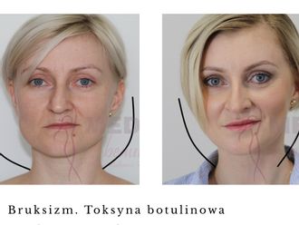 Toksyna botulinowa przed i po - 877111