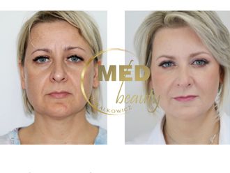 Kwas hialuronowy przed i po - 877112