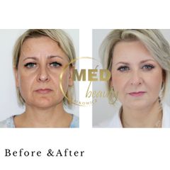 Before &After kwas hialuronowy i toksyna botulinowa.