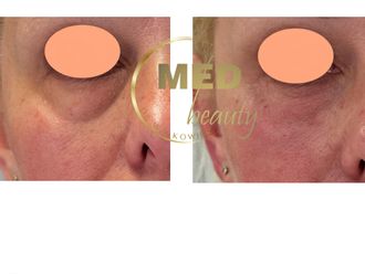 Anti-aging przed i po - 877113