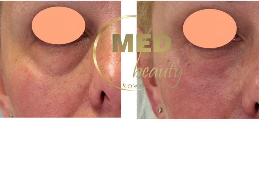 Anti-aging przed i po - 877113