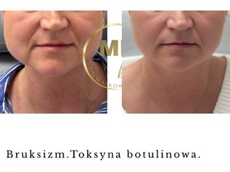 Toksyna botulinowa przed i po - 877114