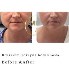 Before &After leczenie bruksizmu