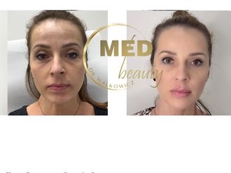 Kwas hialuronowy przed i po - 877115